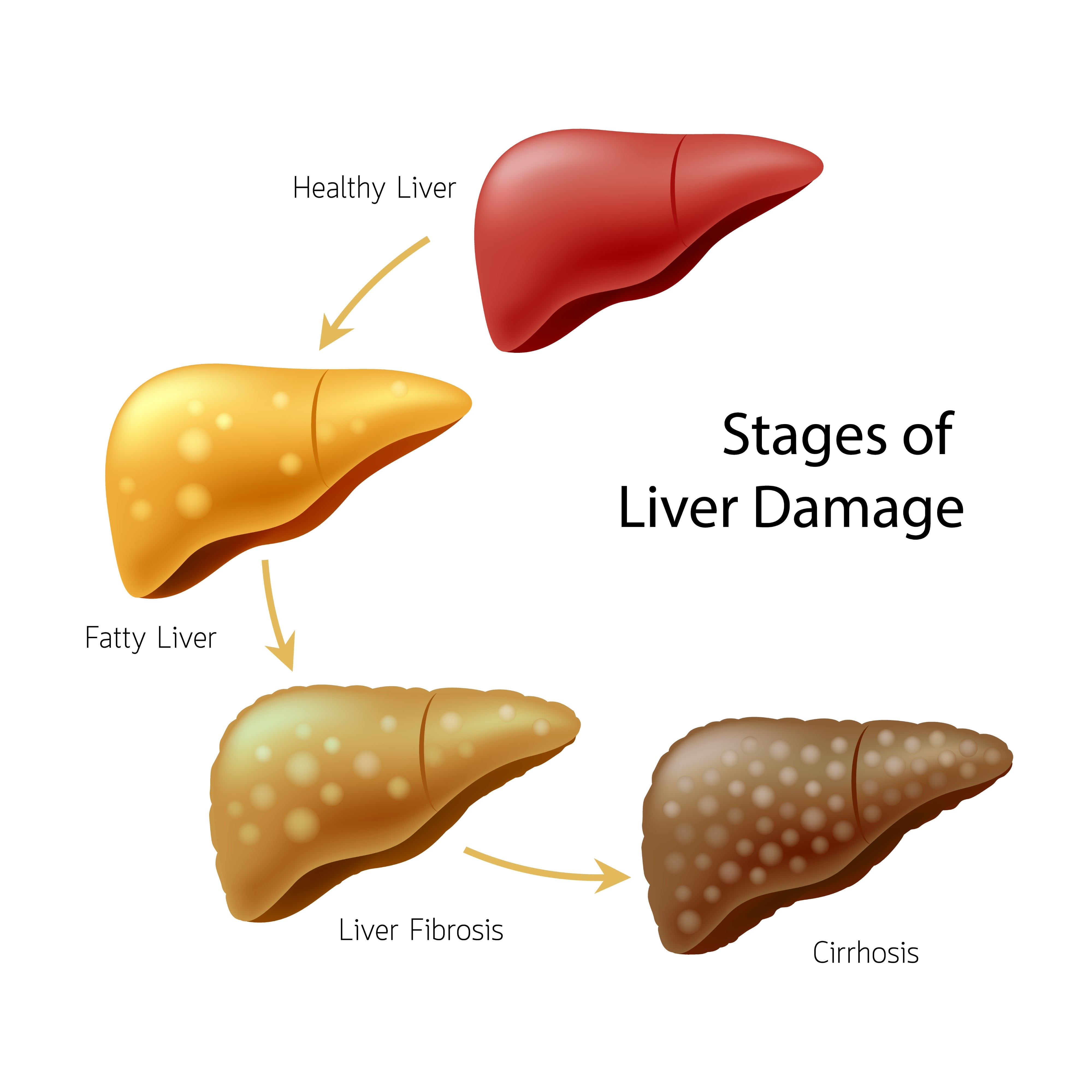 تشمع الكبد (Liver Cirrhosis): كيف نفهمه؟ وكيف نحمي المريض من مضاعفاته؟